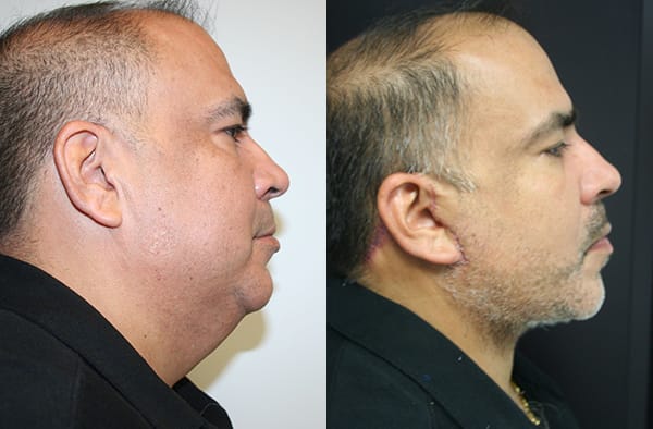 Facelift Before & After - Dr. Thomassen