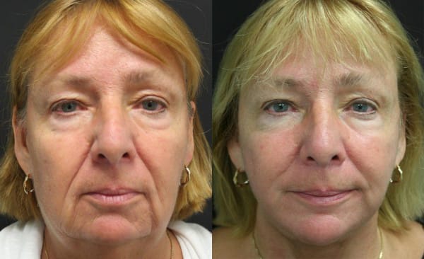 Facelift Before & After - Dr. Thomassen