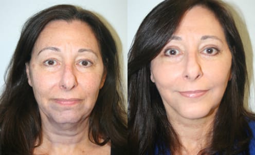 Facelift Before & After - Dr. Thomassen