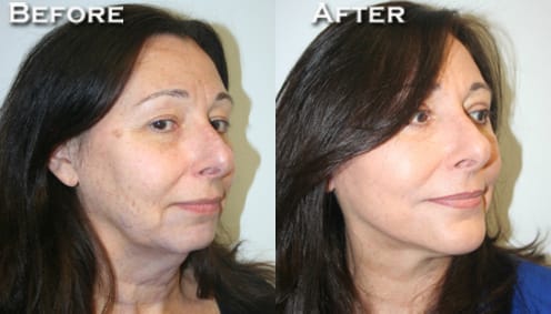 Facelift Before & After - Dr. Thomassen