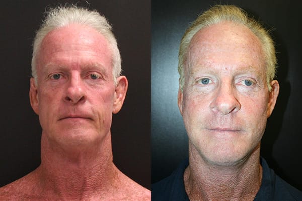 Facelift Before & After - Dr. Thomassen