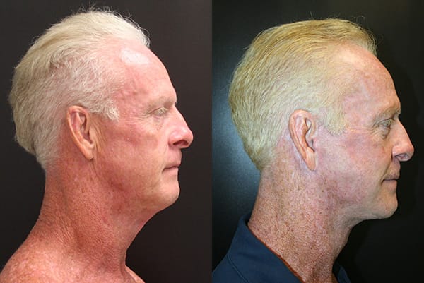 Facelift Before & After - Dr. Thomassen