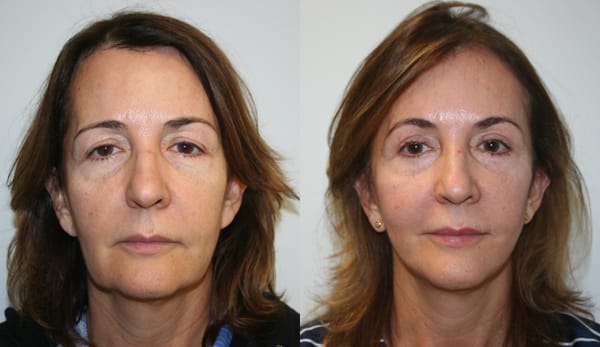 Facelift Before & After - Dr. Thomassen