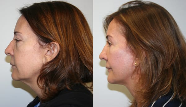 Facelift Before & After - Dr. Thomassen