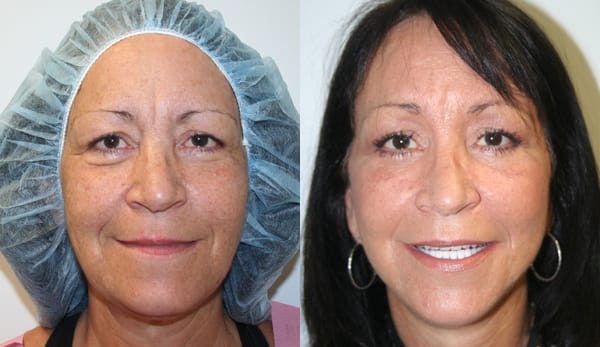 Facelift Before & After - Dr. Thomassen