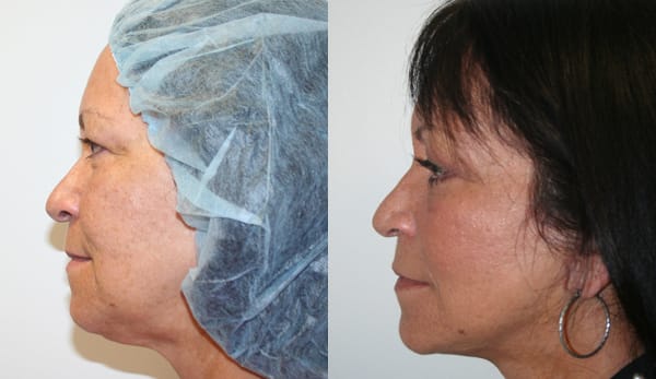 Facelift Before & After - Dr. Thomassen