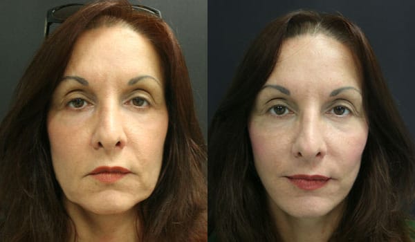 Facelift Before & After - Dr. Thomassen