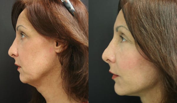 Facelift Before & After - Dr. Thomassen