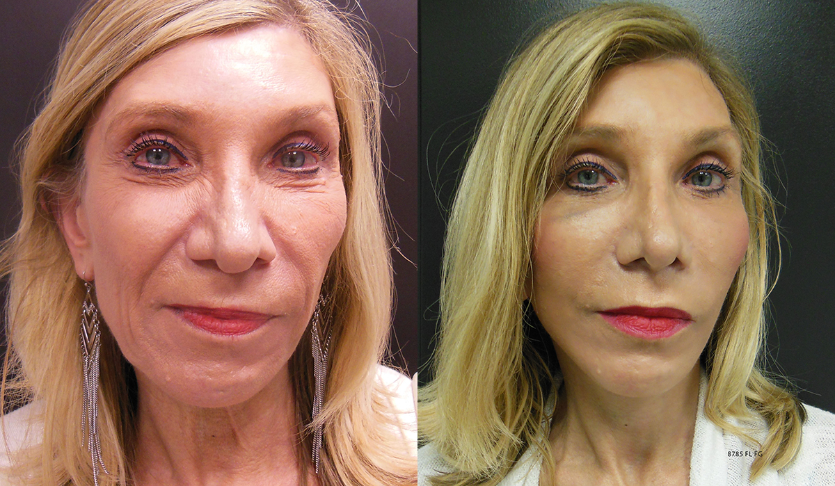 Facelift Before & After - Dr. Thomassen