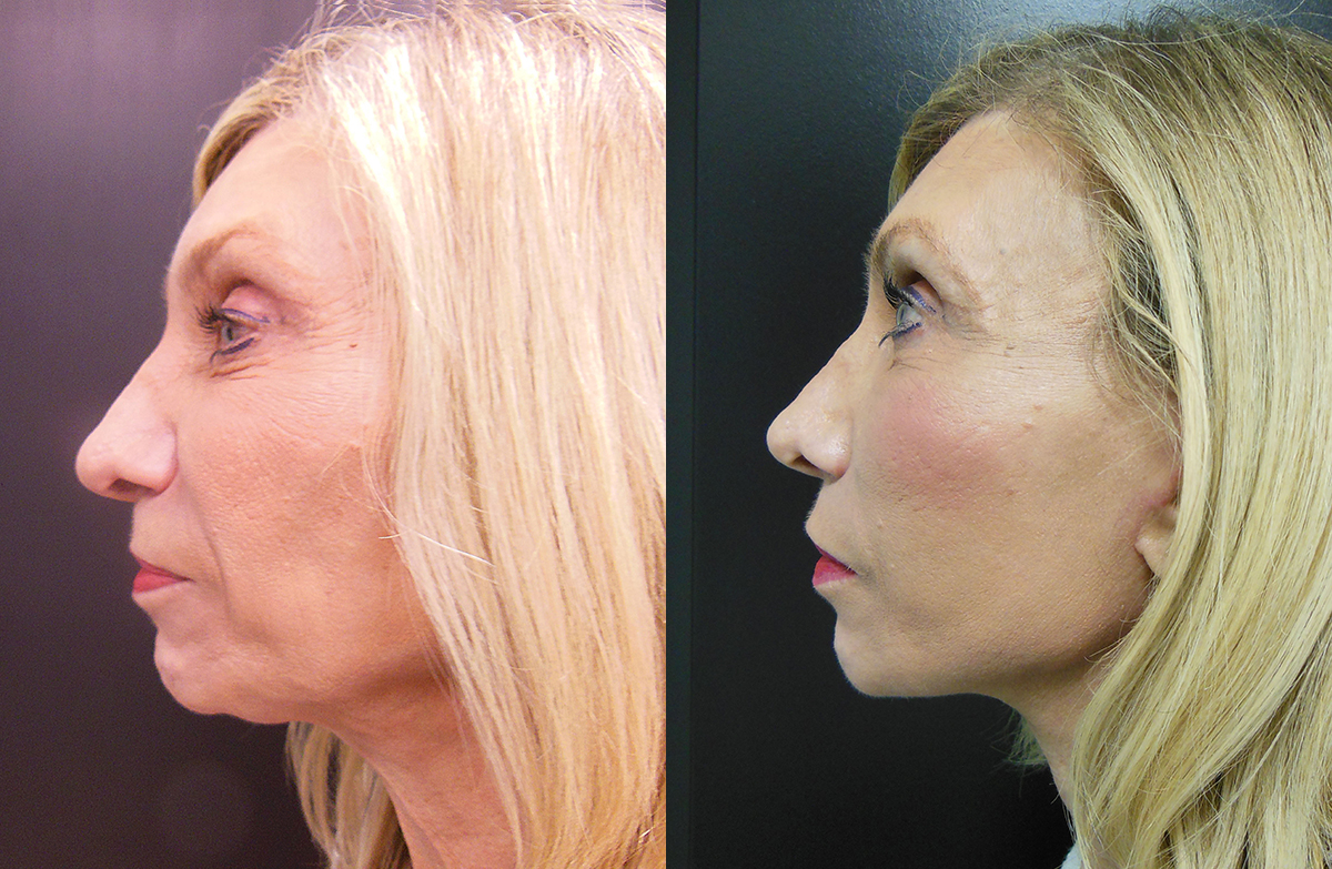 Facelift Before & After - Dr. Thomassen