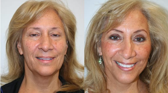 Facelift Before & After - Dr. Thomassen