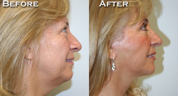 Facelift Before & After - Dr. Thomassen