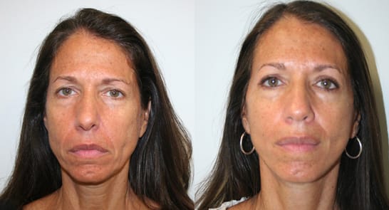 Facelift Before & After - Dr. Thomassen