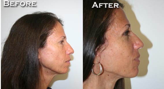 Facelift Before & After - Dr. Thomassen