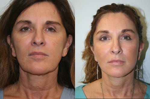 Facelift Before & After - Dr. Thomassen