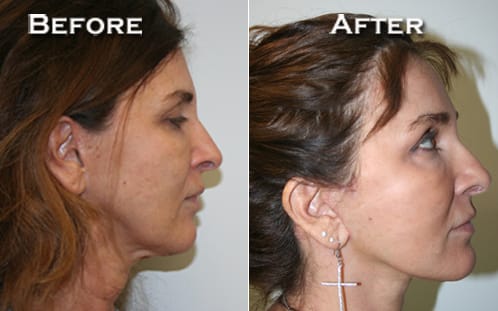 Facelift Before & After - Dr. Thomassen