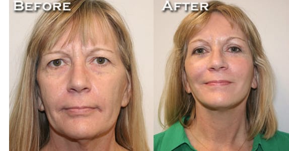 Facelift Before & After - Dr. Thomassen