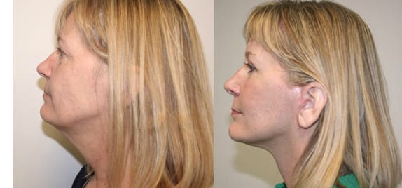 Facelift Before & After - Dr. Thomassen