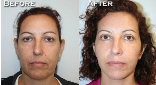 Facelift Before & After - Dr. Thomassen