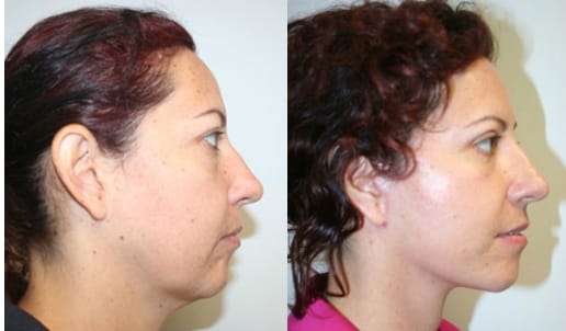 Facelift Before & After - Dr. Thomassen