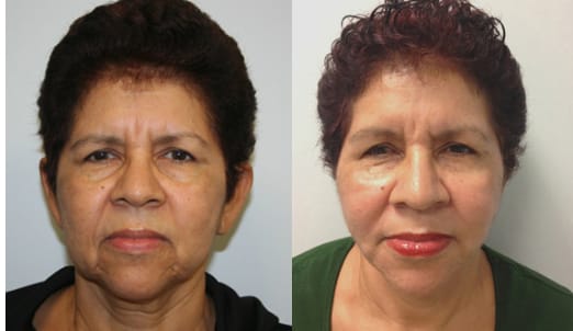 Facelift Before & After - Dr. Thomassen