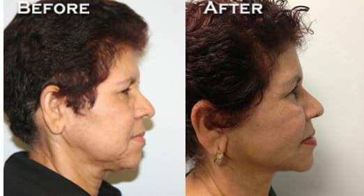 Facelift Before & After - Dr. Thomassen