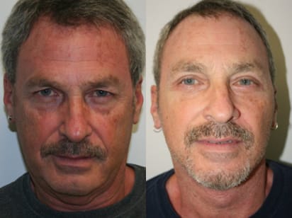 Facelift Before & After - Dr. Thomassen