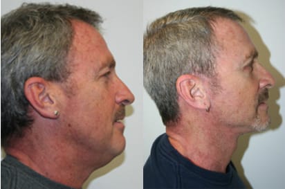 Facelift Before & After - Dr. Thomassen