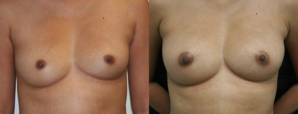 Fat Grafting Before & After - Dr. Thomassen
