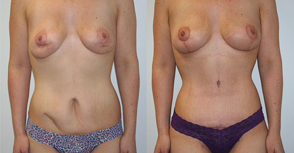 Fat Grafting Before & After - Dr. Thomassen