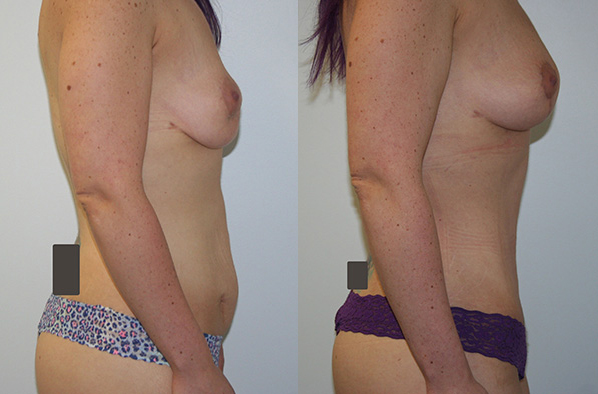 Fat Grafting Before & After - Dr. Thomassen