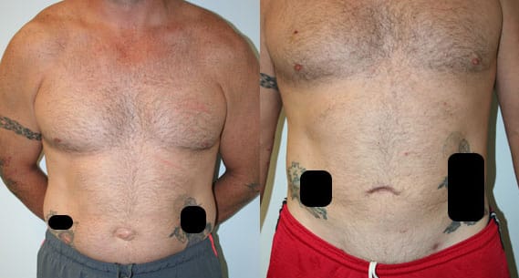 Liposuction Before & After - Dr. Thomassen