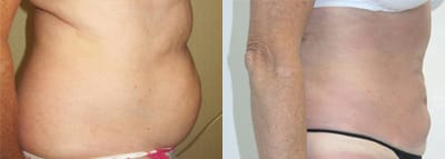 Liposuction Before & After - Dr. Thomassen