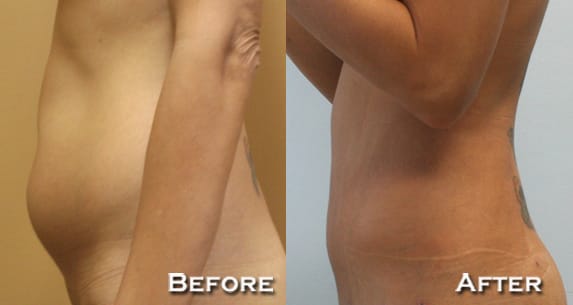 Liposuction Before & After - Dr. Thomassen
