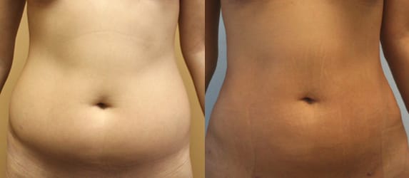 Liposuction Before & After - Dr. Thomassen