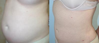 Liposuction Before & After - Dr. Thomassen