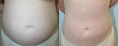Liposuction Before & After - Dr. Thomassen