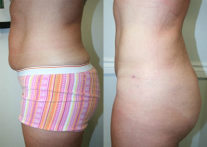 Liposuction Before & After - Dr. Thomassen