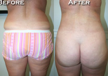 Liposuction Before & After - Dr. Thomassen