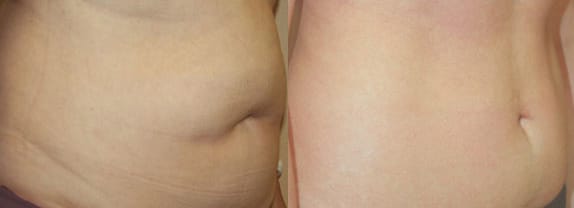 Liposuction Before & After - Dr. Thomassen