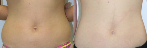 Liposuction Before & After - Dr. Thomassen