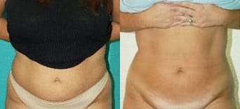 Liposuction Before & After - Dr. Thomassen