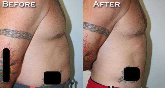 Liposuction Before & After - Dr. Thomassen
