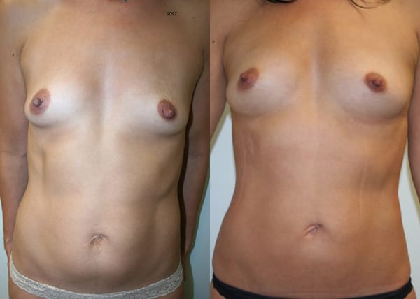 Liposuction Before & After - Dr. Thomassen