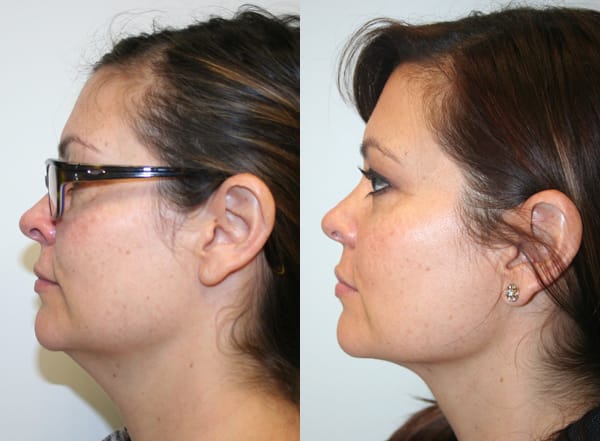 Liposuction Before & After - Dr. Thomassen
