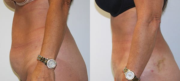 Liposuction Before & After - Dr. Thomassen