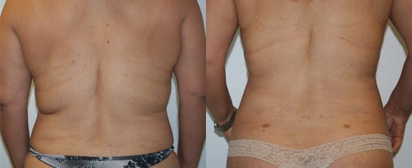 Liposuction Before & After - Dr. Thomassen