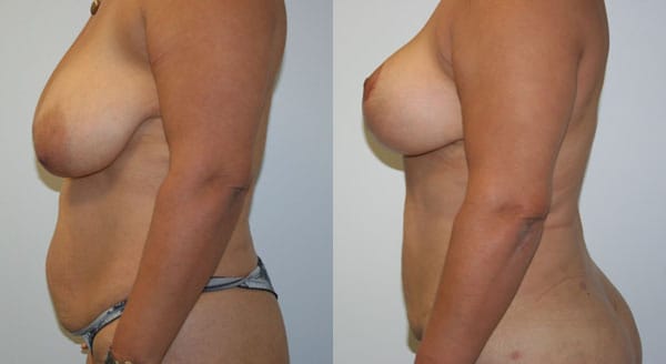 Liposuction Before & After - Dr. Thomassen