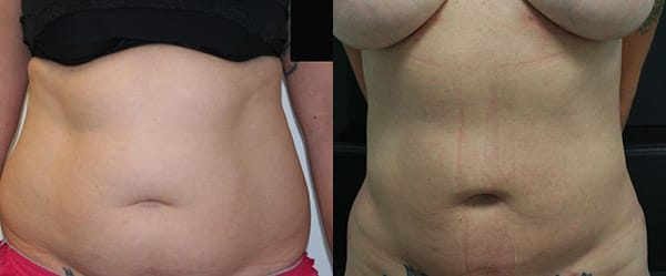 Liposuction Before & After - Dr. Thomassen