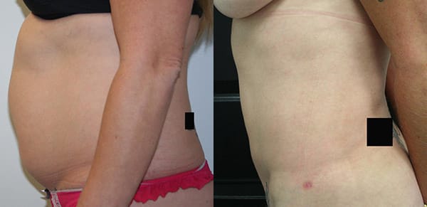 Liposuction Before & After - Dr. Thomassen